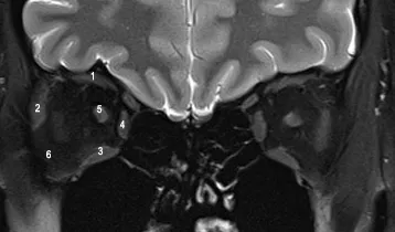 patient-without-thyroid-eye-disease-mri