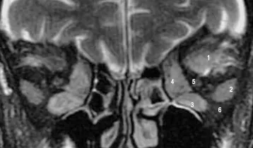 severe-thyroid-eye-disease-mri