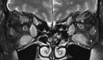 thyroid-ophthalmopathy-radiology