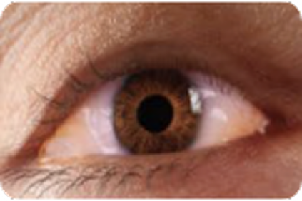 chemosis