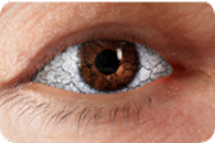 Dry eye and grittiness