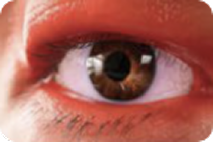 eyelid_erythema