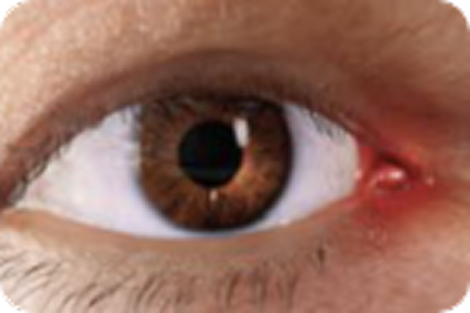 Inflammation of caruncle or plica