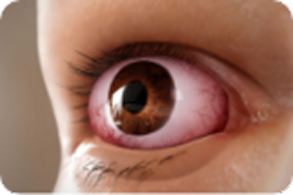 proptosis_eye