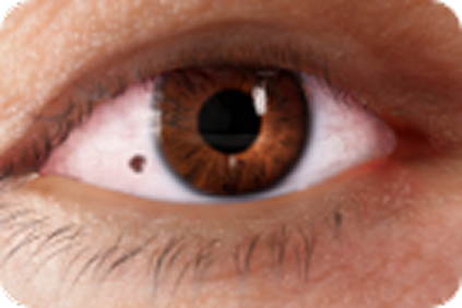 Feeling of something stuck in the eye