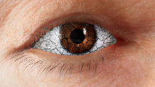 Artistic rendering of dry, gritty eyes caused by Thyroid Eye Disease