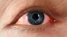 Artistic rendering of eye redness, swelling, and excessive tearing caused by Thyroid Eye Disease