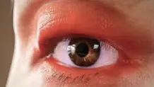 Artistic rendering of eyelid erythema