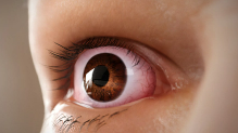 Artistic rendering of eyelid retraction, a common symptom of Thyroid Eye Disease