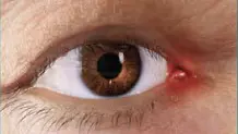 Artistic rendering of eye inflammation of the caruncle or plica