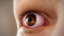 Artistic rendering of proptosis, a common symptom of Thyroid Eye Disease
